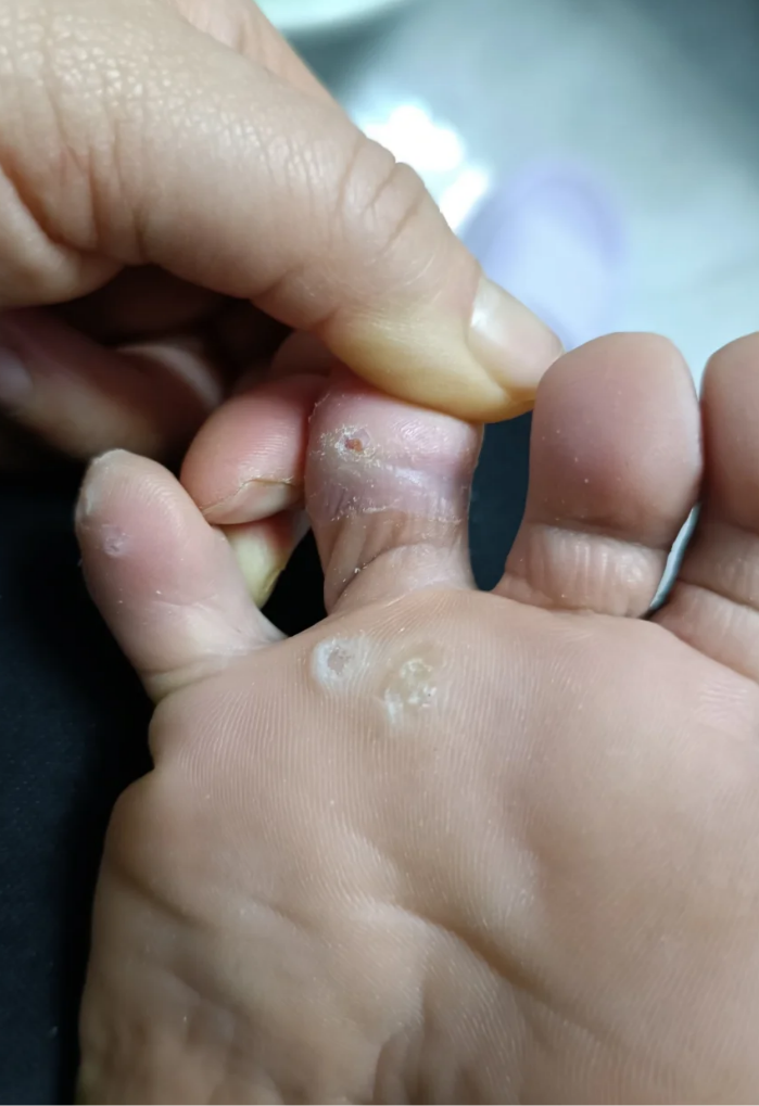 脚底长了一个硬包,是什么?按压会痛,不按