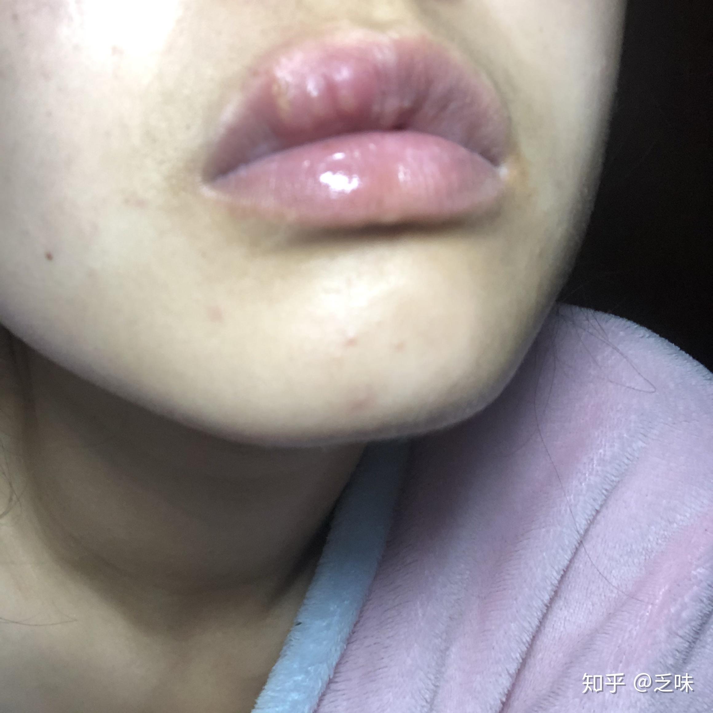 嘴唇上起小水泡,很小的