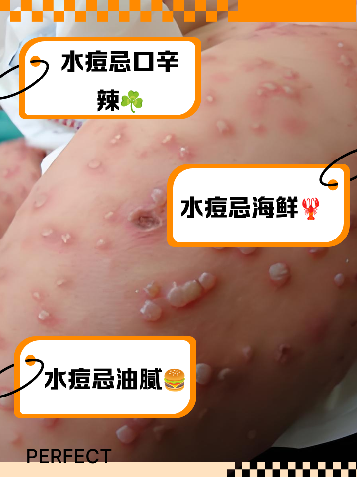 水痘传染期是多少天
