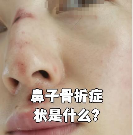 鼻子骨折会自我恢复吗