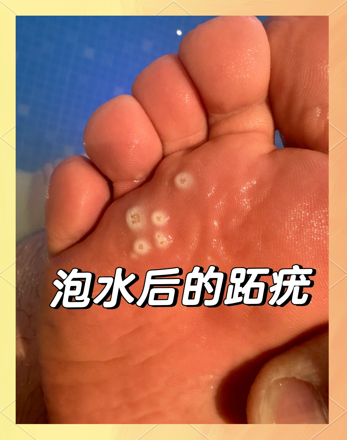 跖疣怎么治能断根