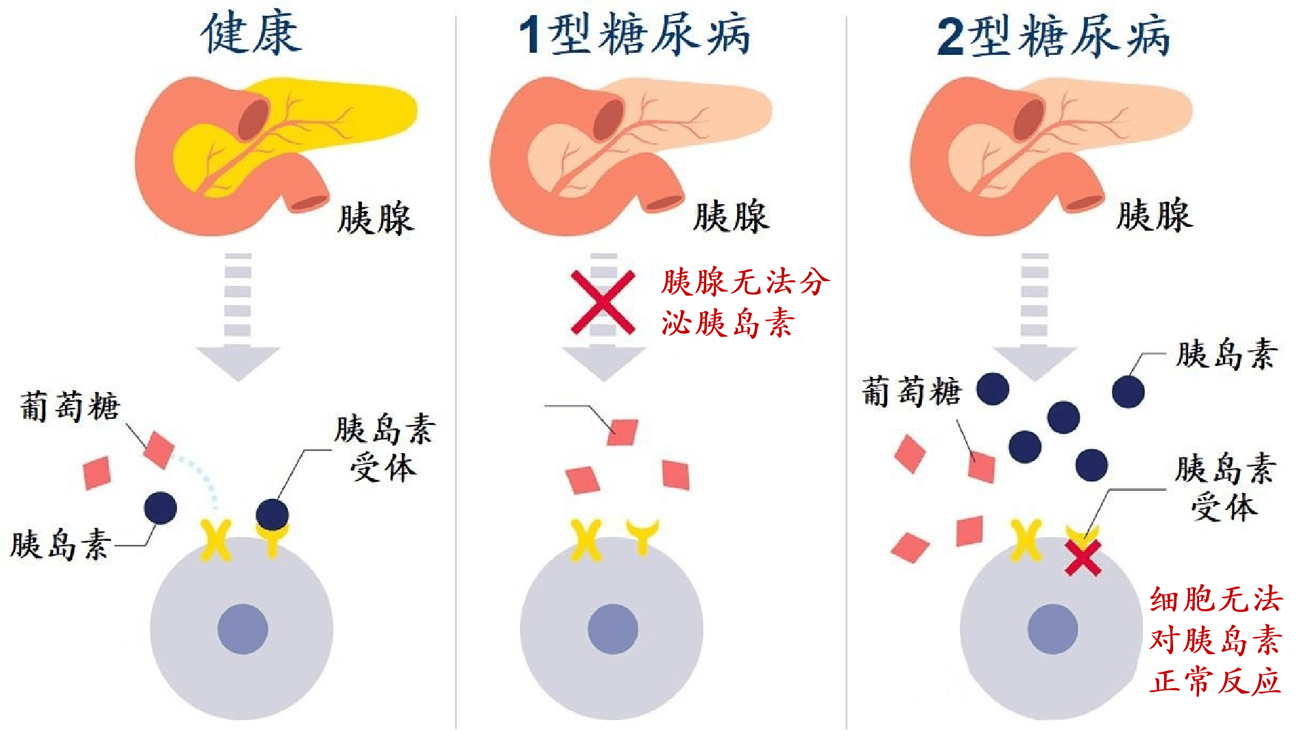 糖尿病有哪些类型