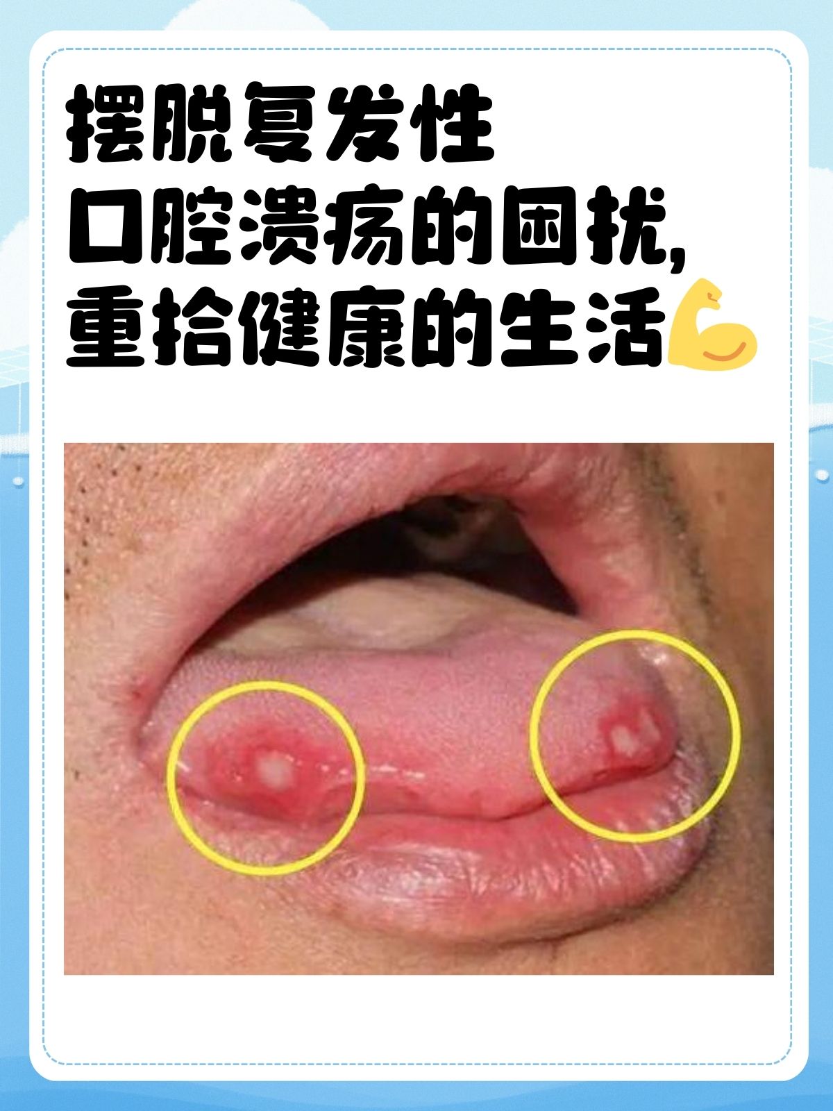 为什么会出现口腔溃疡