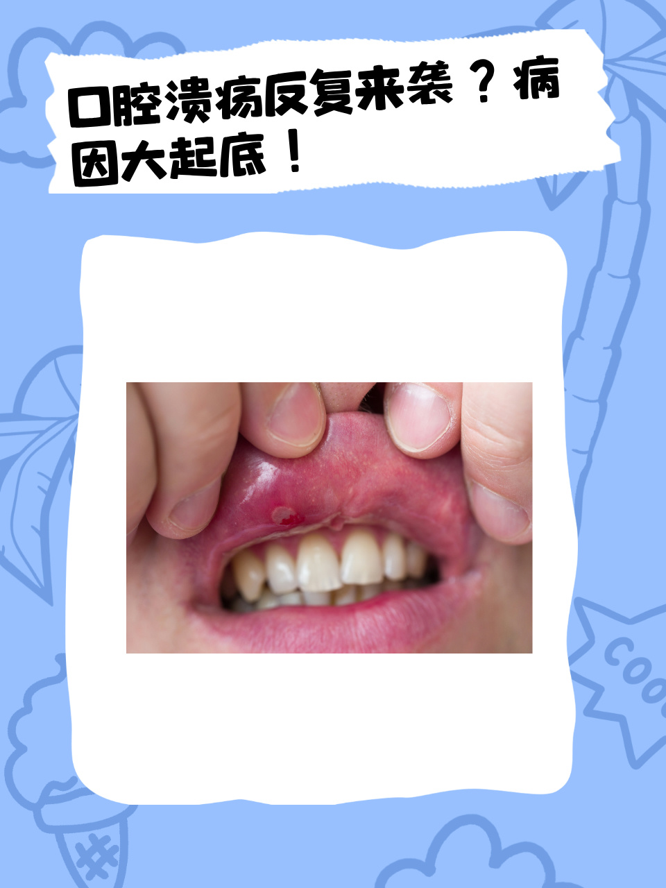 为什么会出现口腔溃疡