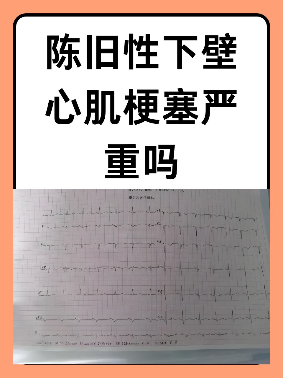 心肌梗塞病严重吗