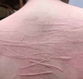 皮肤划痕症