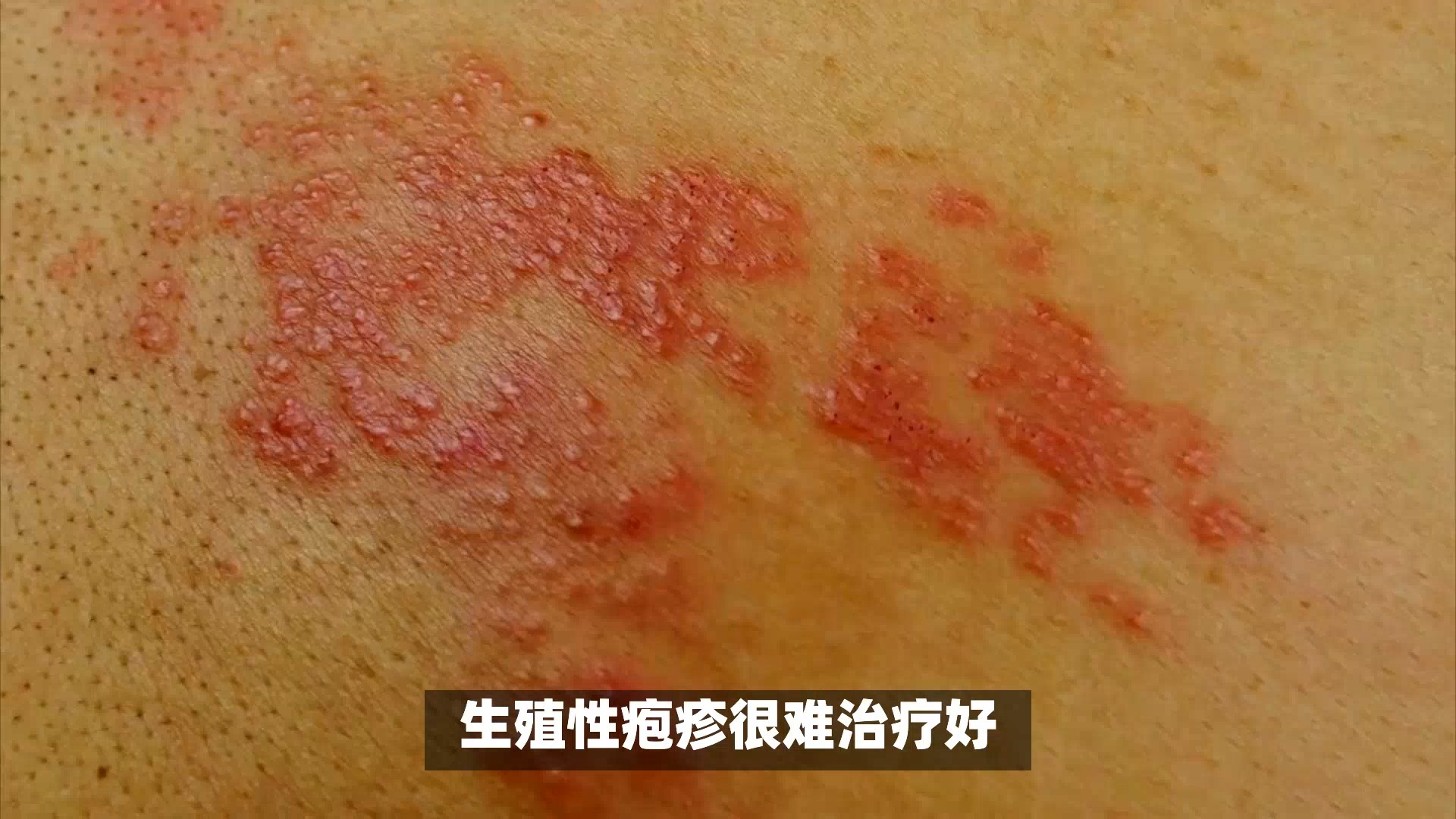 性病是什么病?