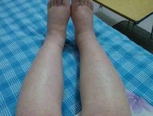 下肢血栓的症状有哪些?