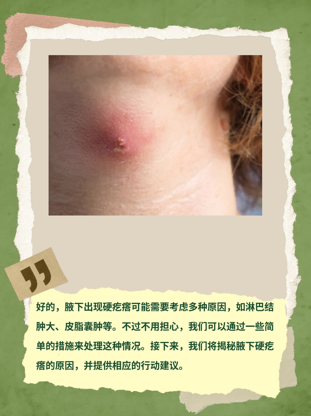 腋下长了个疙瘩很疼,怎么办