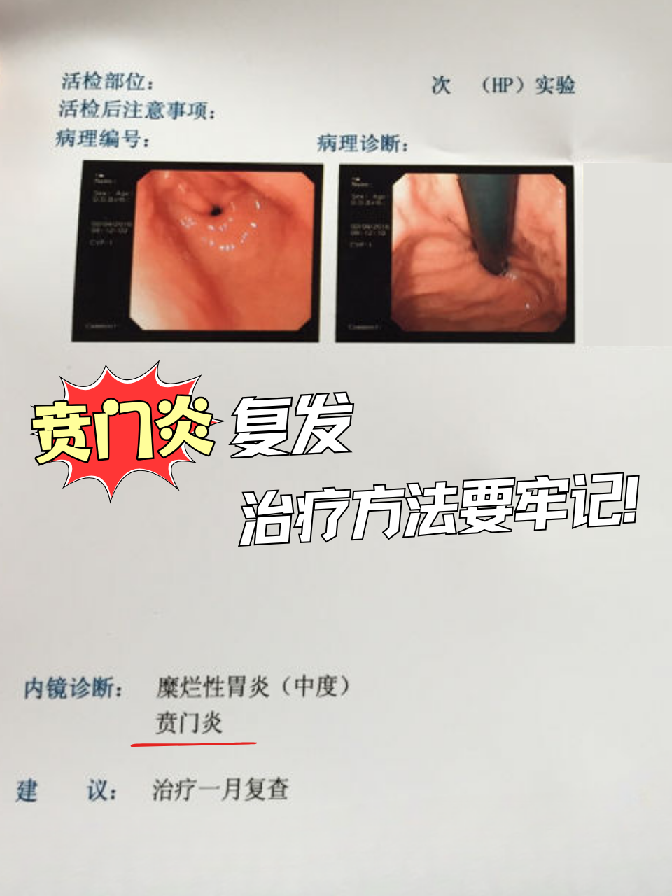贲门癌晚期怎么治疗
