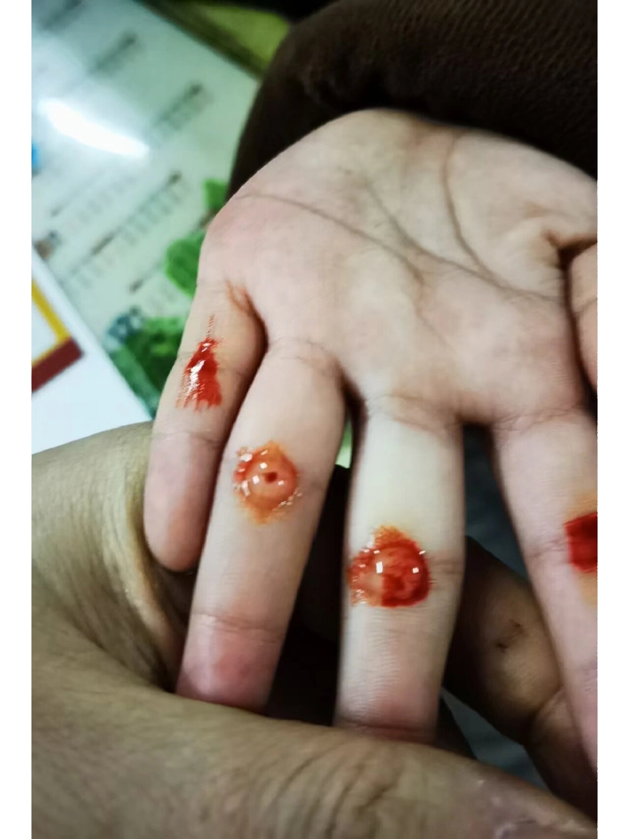 小儿疳积是什么病?有什么症状?