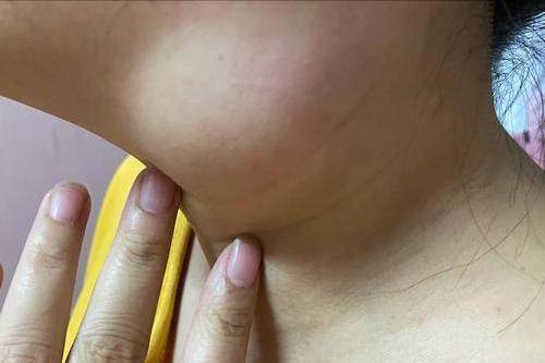 慢性淋巴性甲状腺炎有什么表现