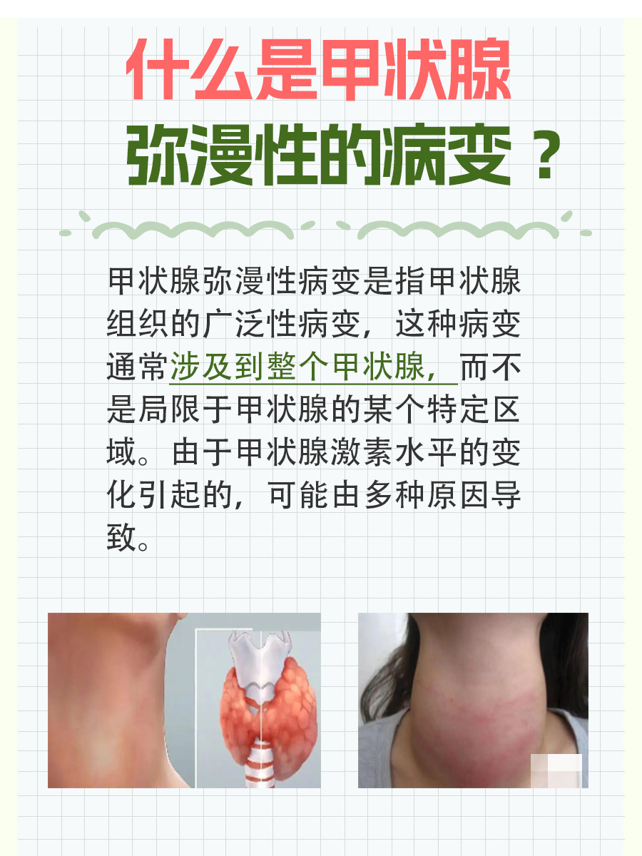 慢性淋巴性甲状腺炎有什么表现