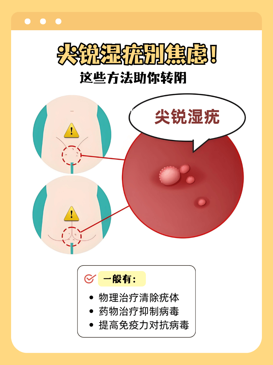 如何治疗尖锐湿疣?