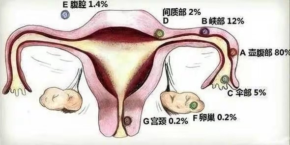 宫外孕是怎么造成的?