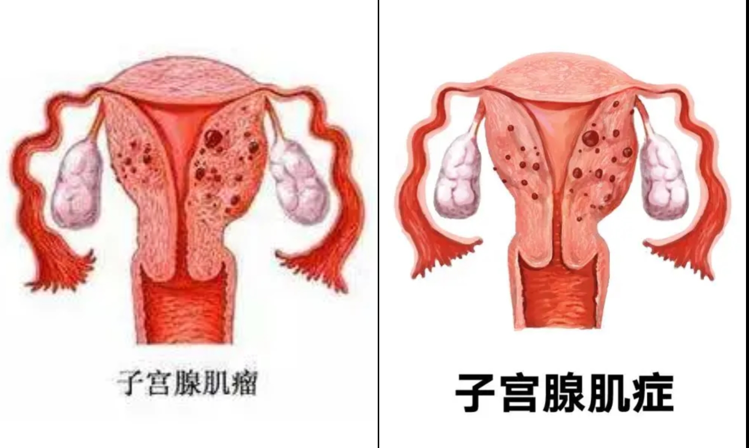 肌壁间子宫肌瘤的危害
