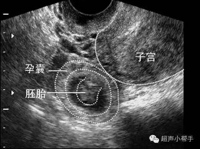 异位妊娠什么意思