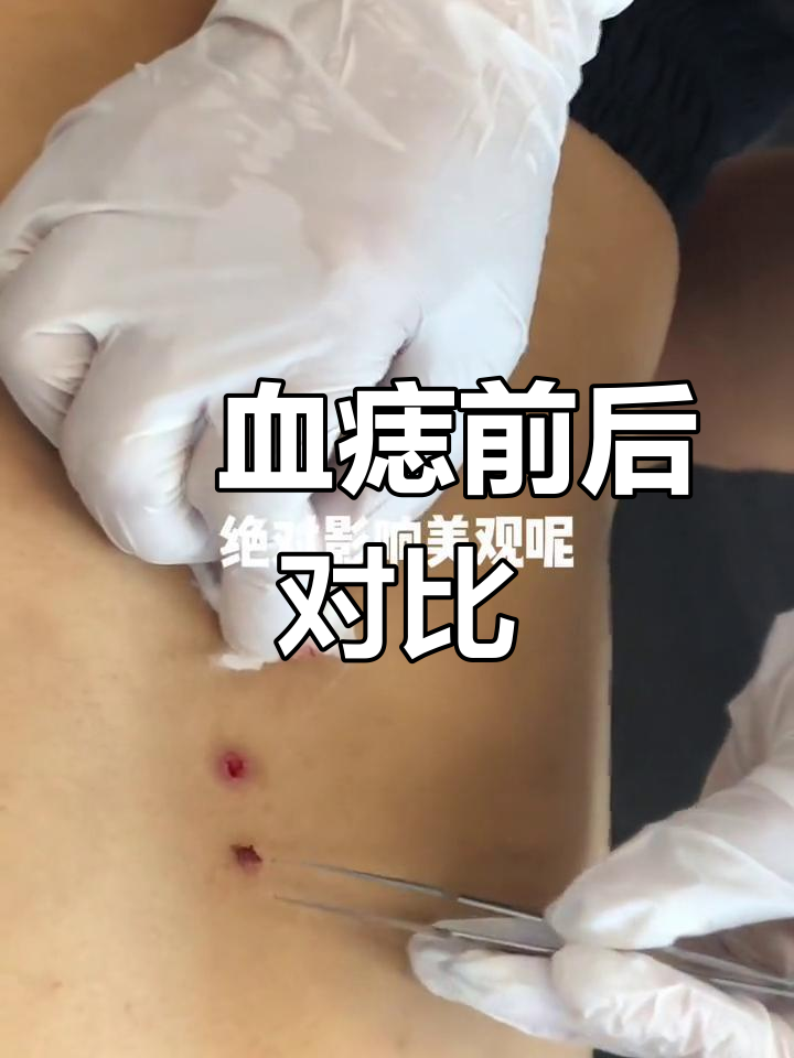 身上长了很多红痣怎么办?