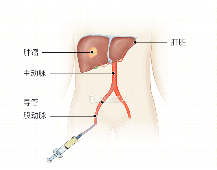 什么是肝癌介入治疗
