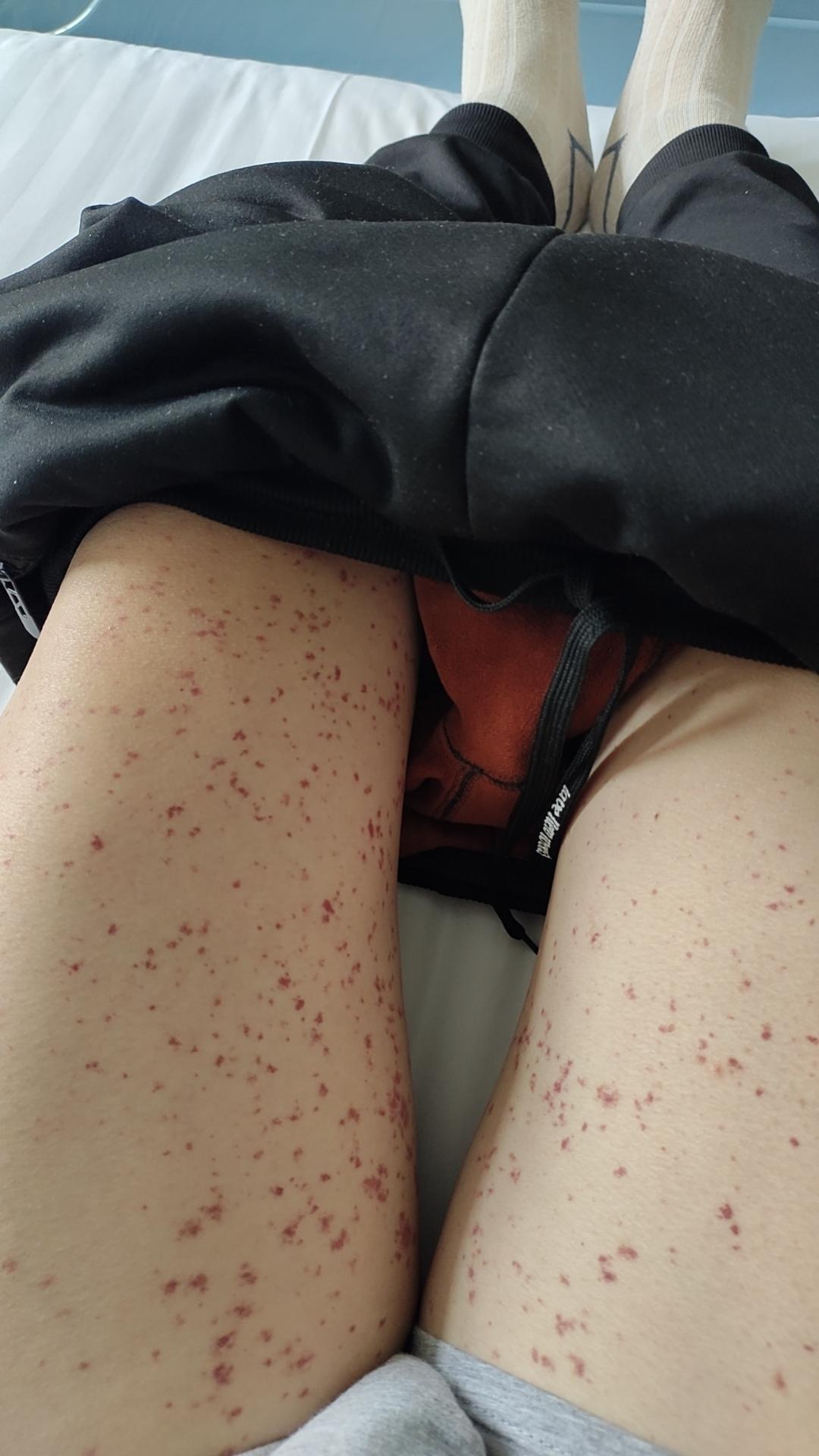紫癜能治好吗严重吗