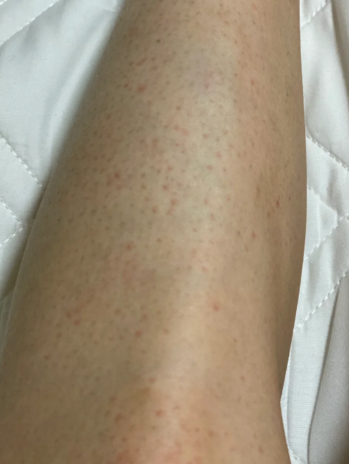 大腿上有红点点不痛不痒