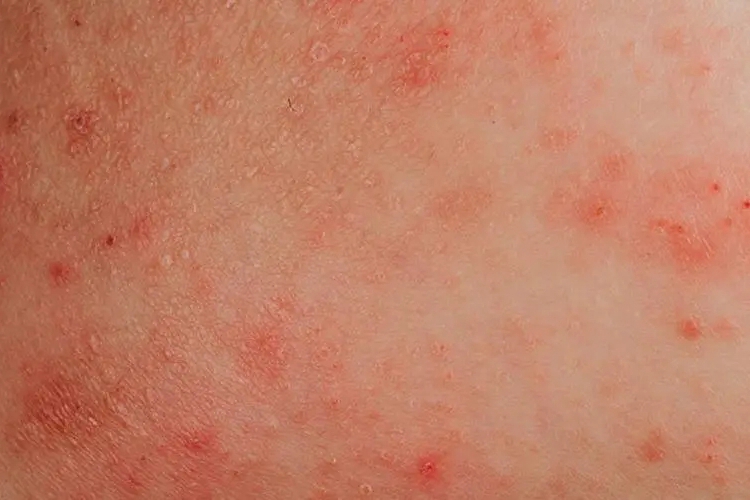 白血病的初期症状有几种