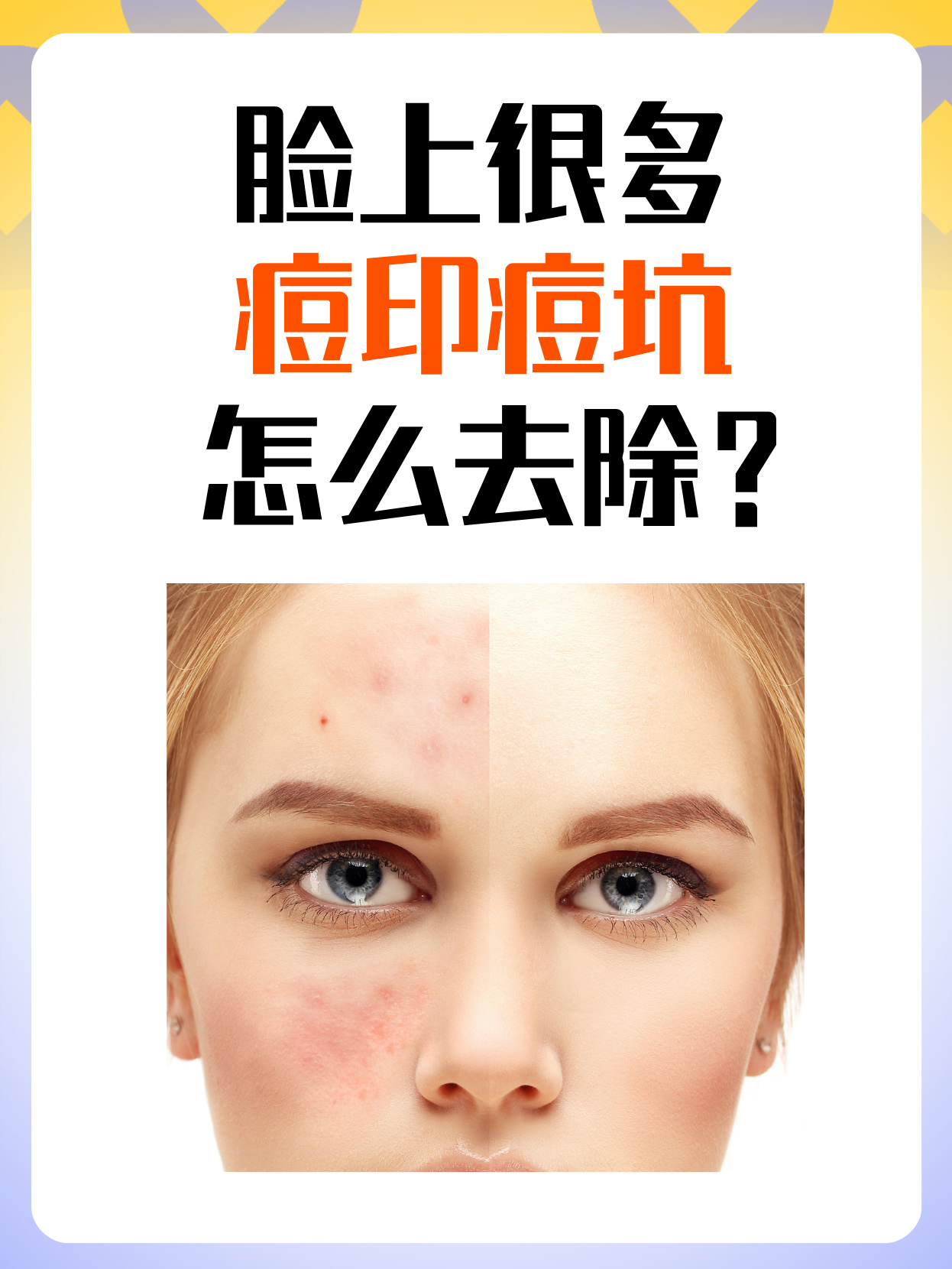 痘印怎么去除?