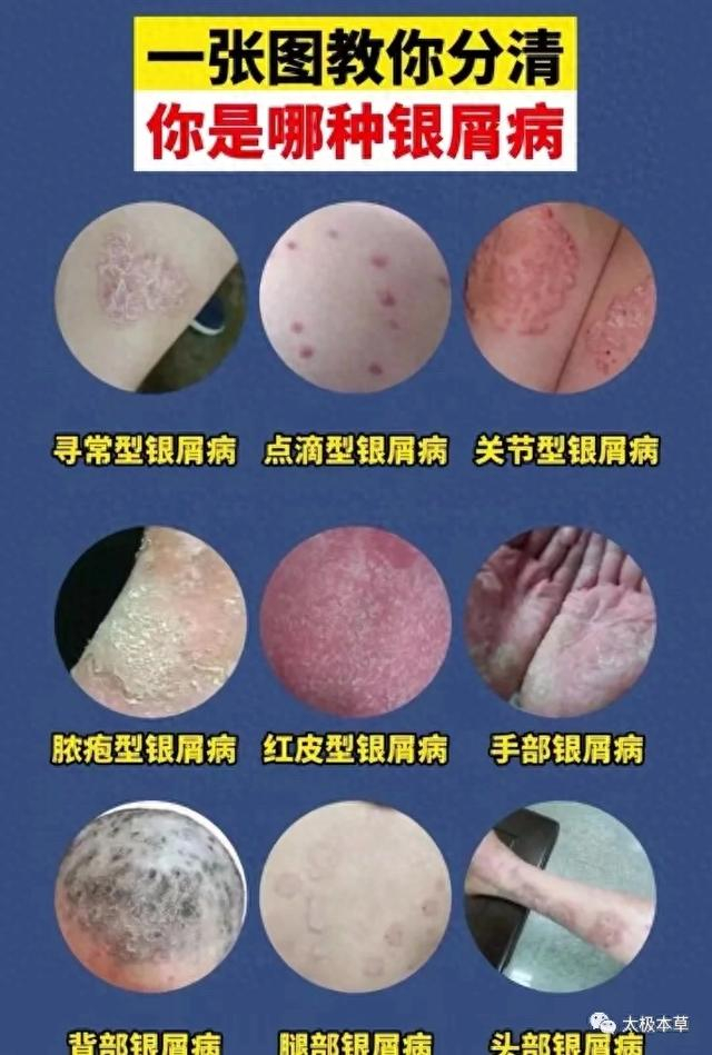 银屑病治疗效果好的方法