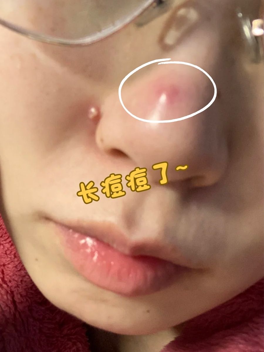 鼻子长痘怎么办