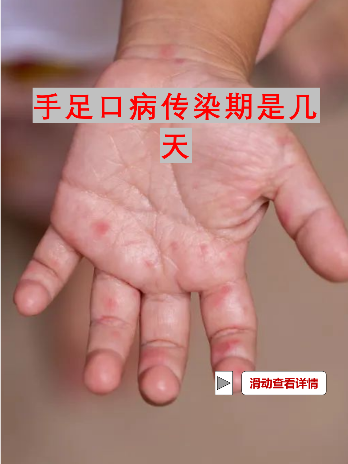 手足口病通过什么传染