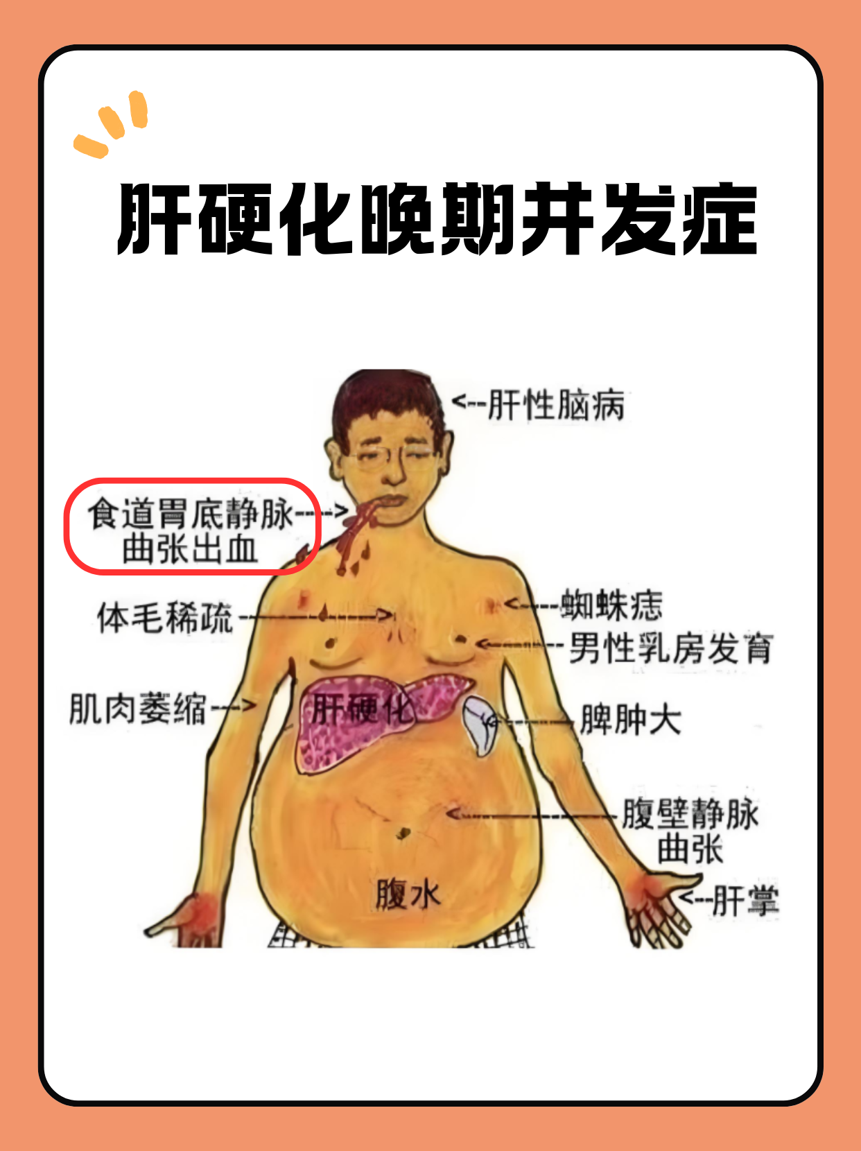 肝硬化最常见的并发症是什么