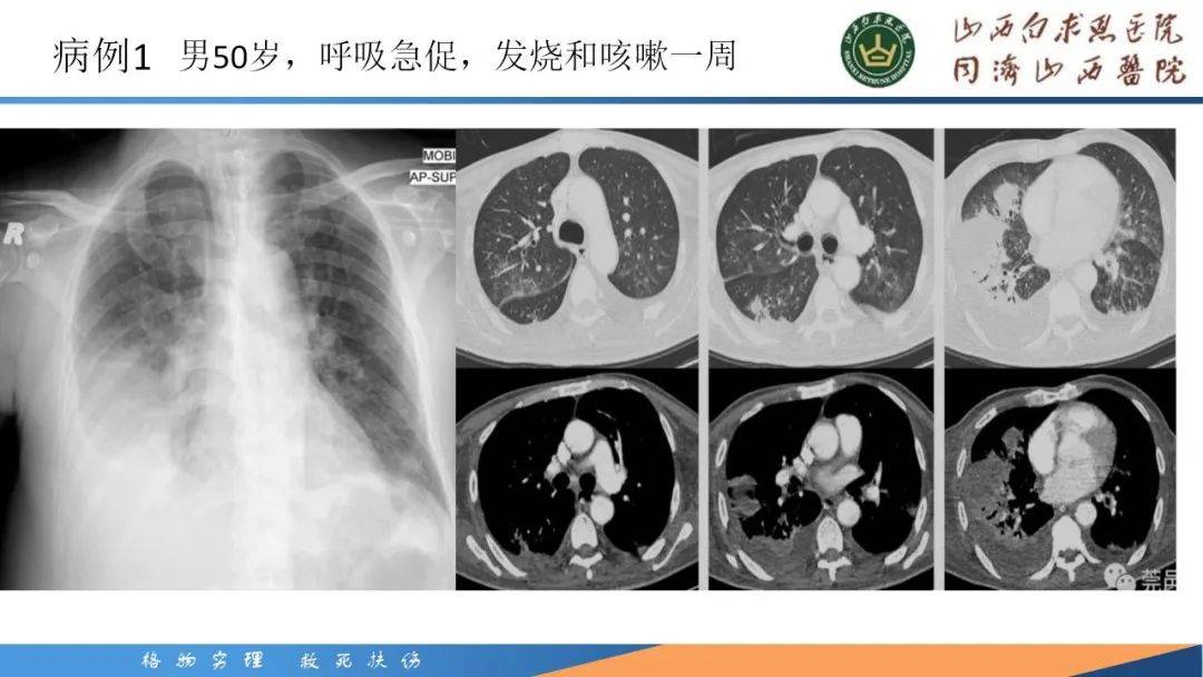 克雷伯杆菌肺炎是什么病