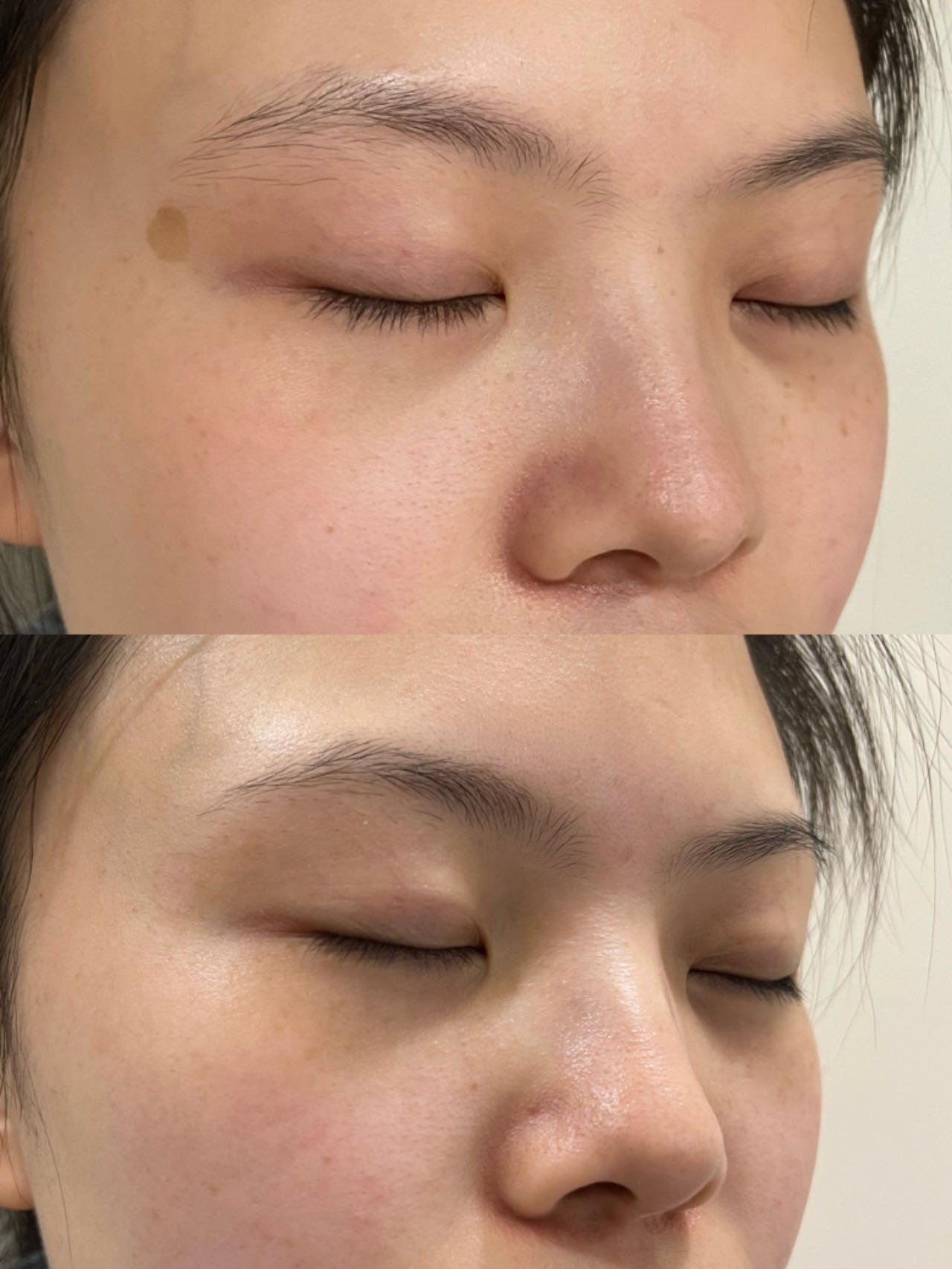 激光祛斑后多久可以化妆?