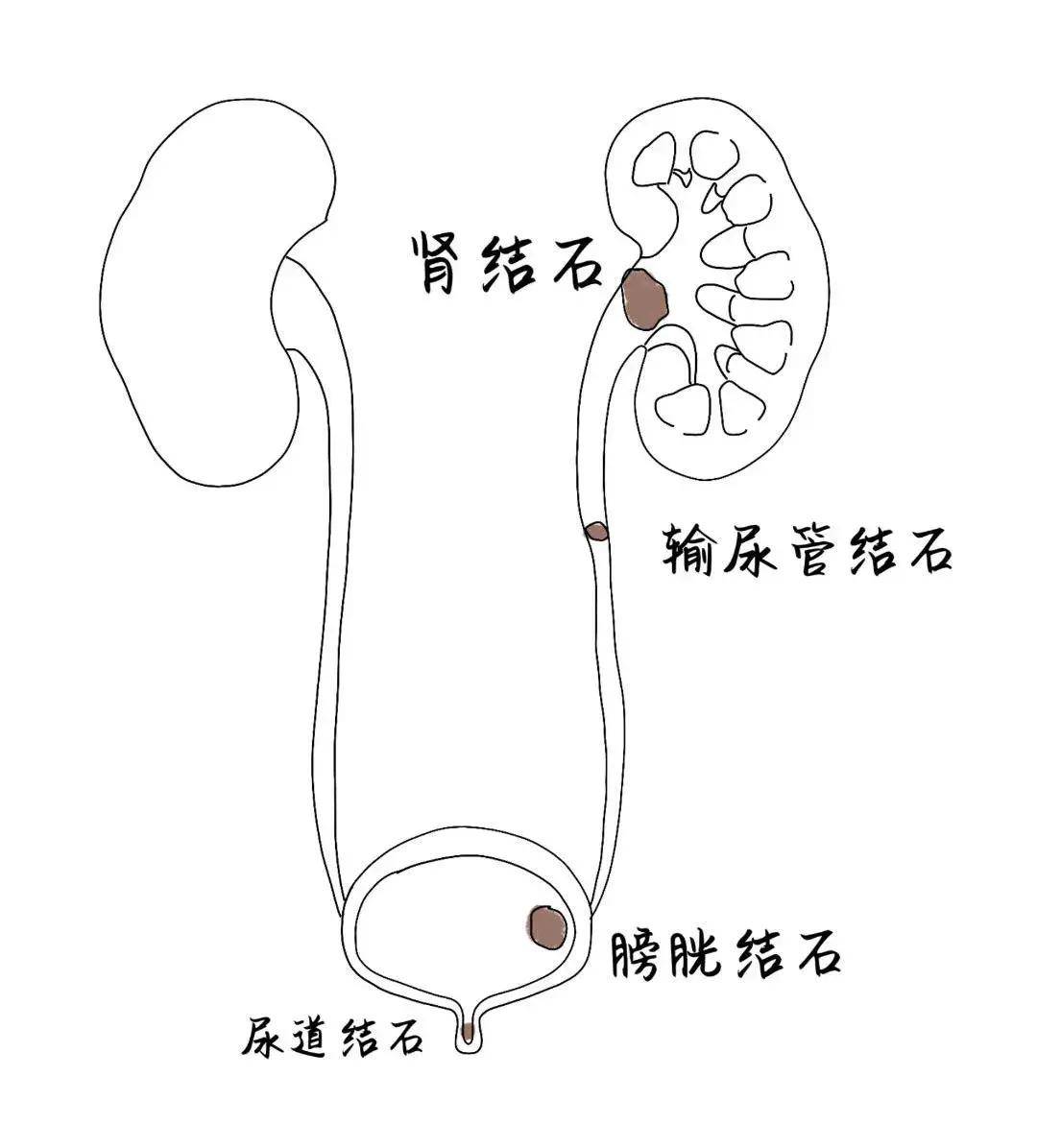 结石有几种