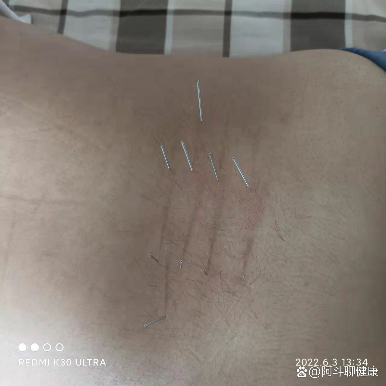 腰椎间盘突出针灸穴位