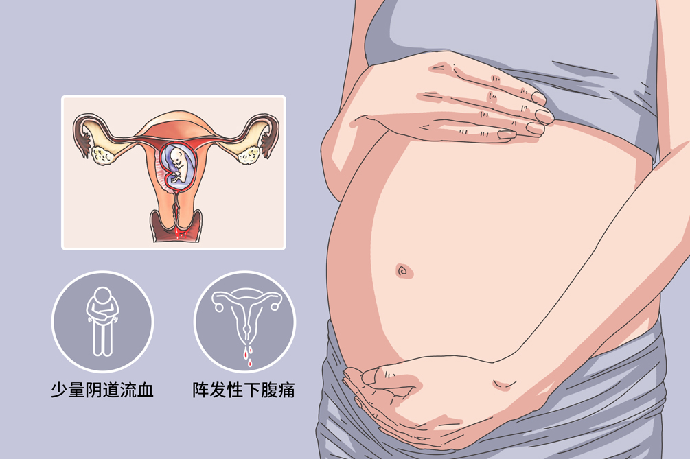 先兆流产症状