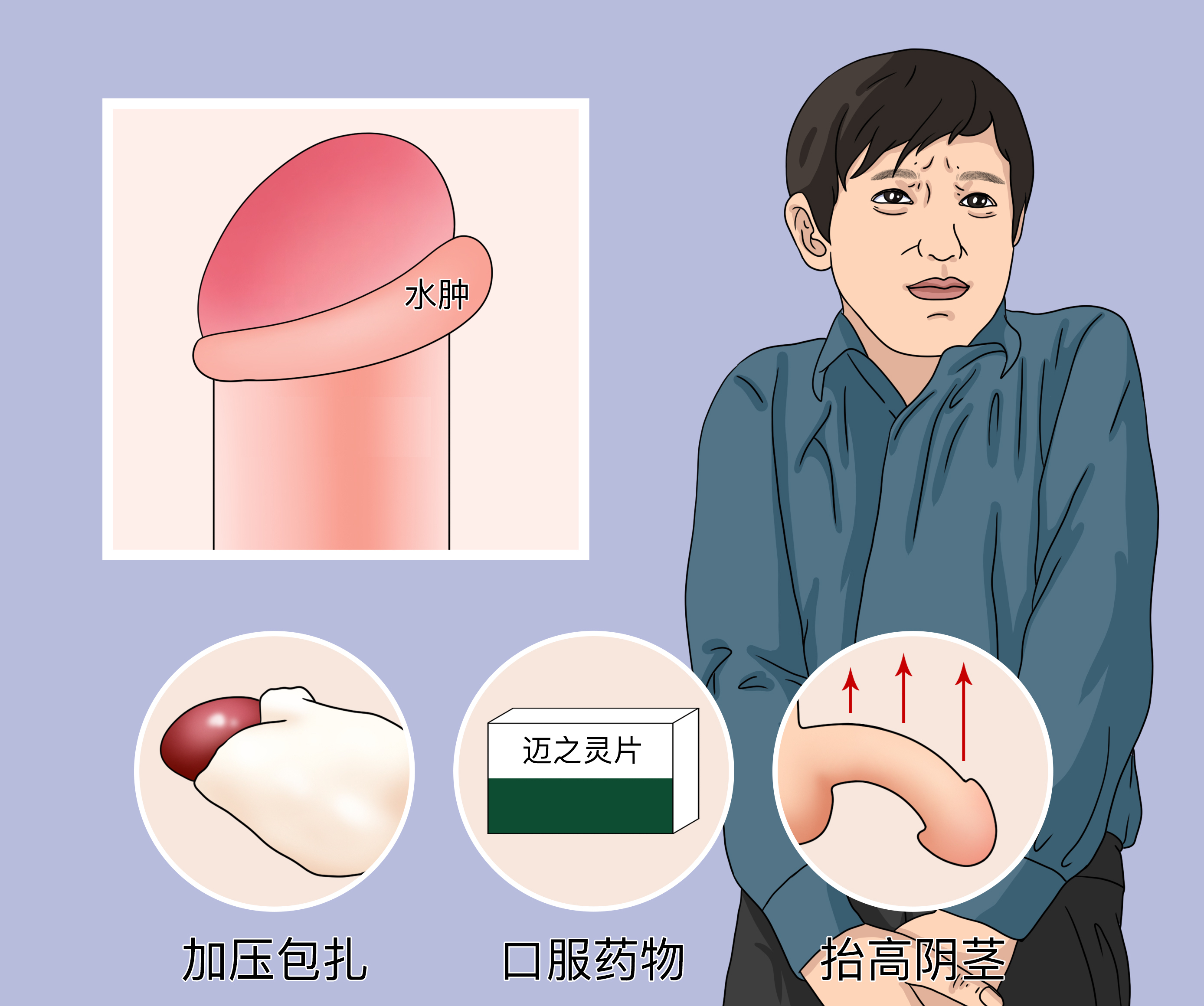 包皮手术后一个月还是有水肿,早上起来水肿