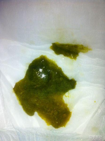 便便绿色的正常吗?