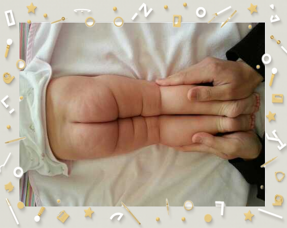 宝宝腿纹不对称怎么回事