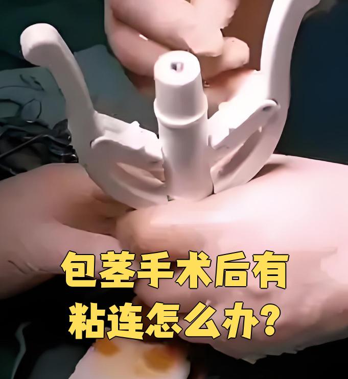 这是我包皮手术12天后的样子