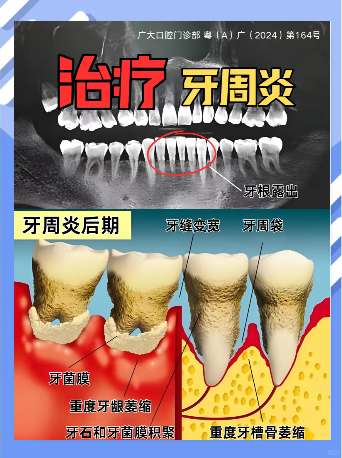 什么叫牙周炎