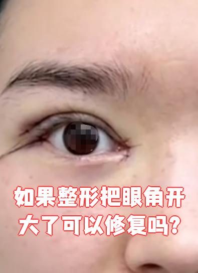 眼角开大怎么修复