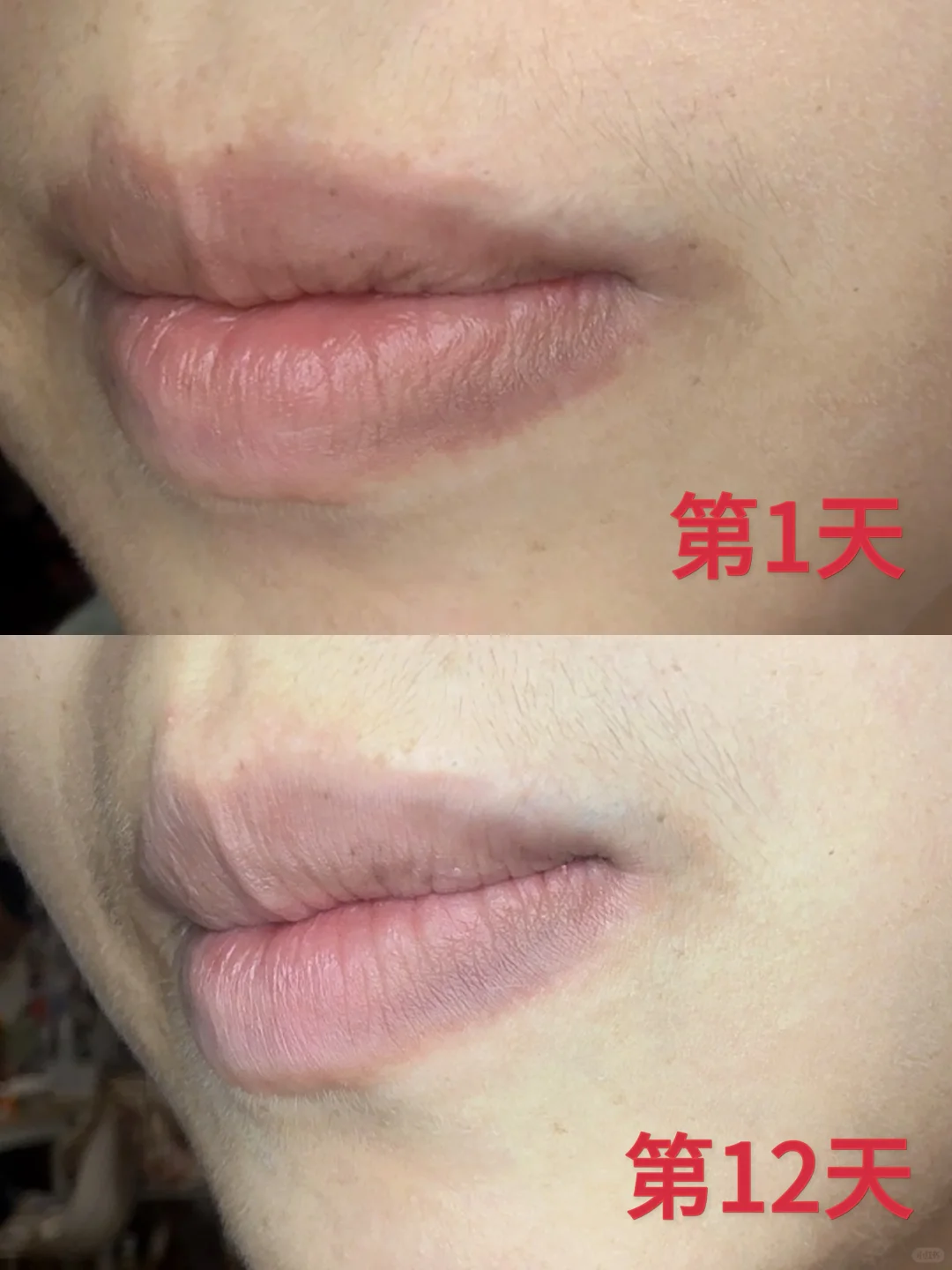 嘴唇周围发黑怎么去除
