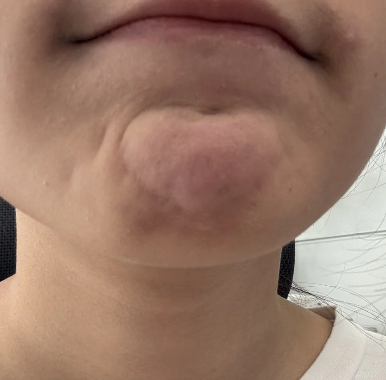 下巴下面有一个硬疙瘩