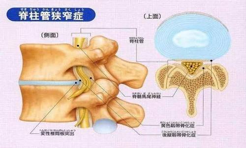 什么是腰椎管狭窄