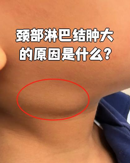 颈部淋巴结肿大什么原因