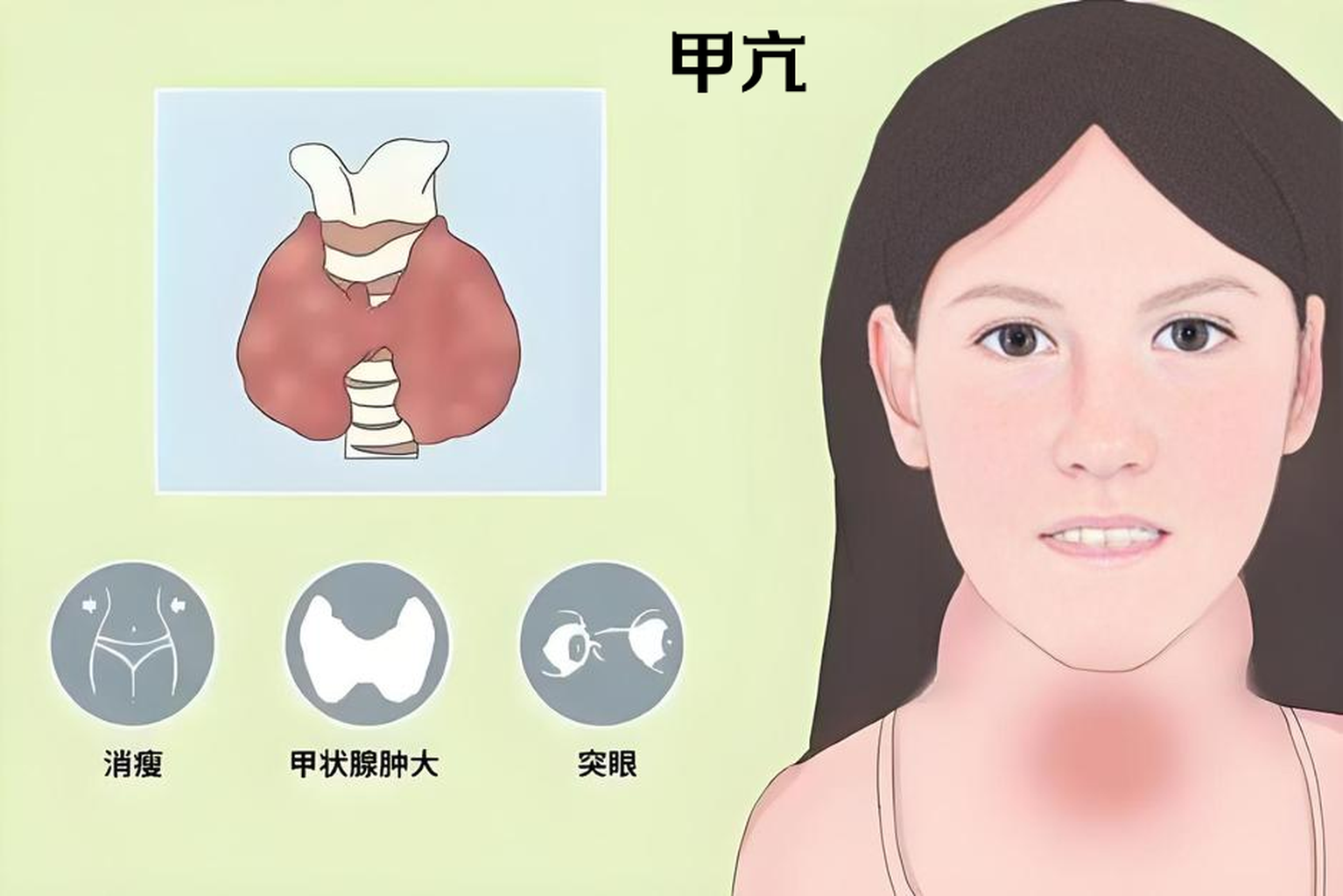 甲亢早期好治吗