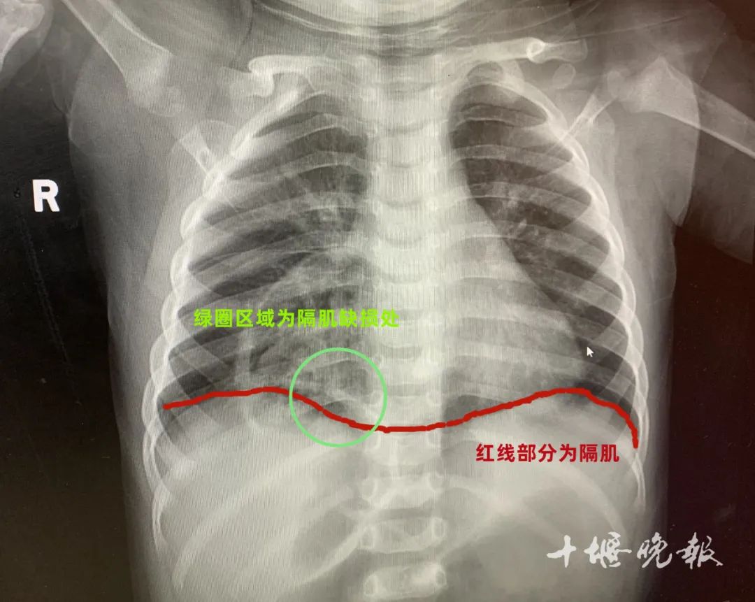 膈疝是什么
