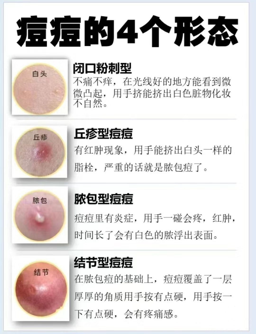 挤痘痘的正确方法是什么