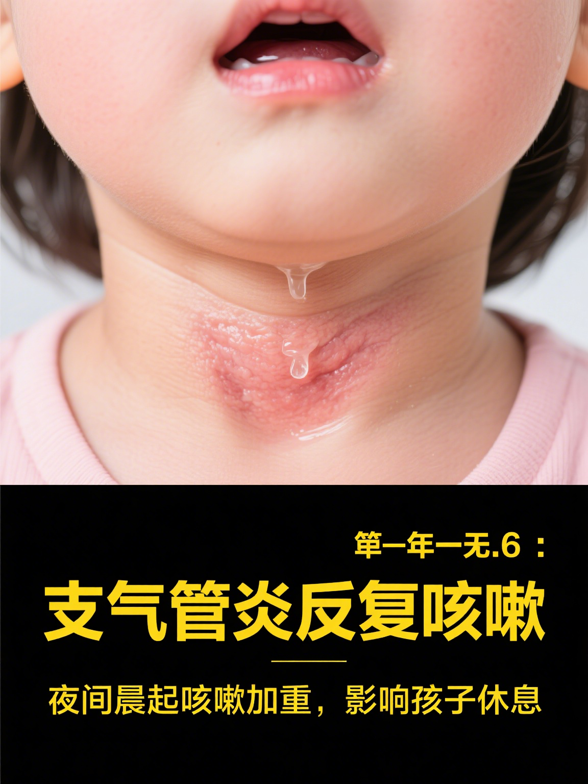 小儿支气管炎症状具体有哪些